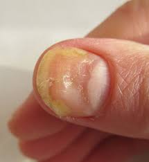 Nail Fungus