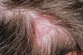 Scalp Ringworm
